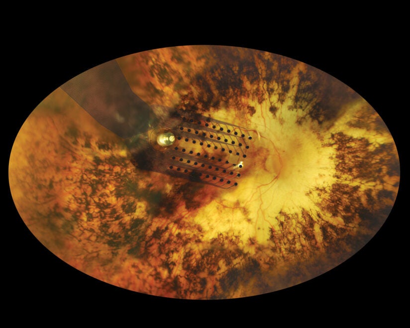Argus II retinal implant