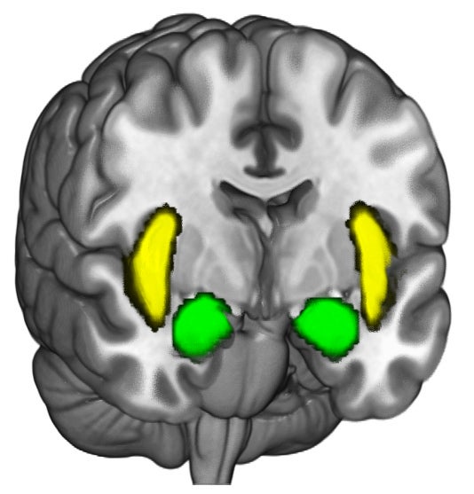 brain scan with amygadalae marked