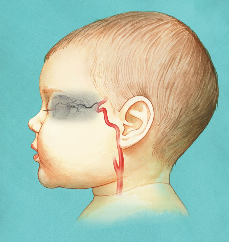 children's eye cancer treatment