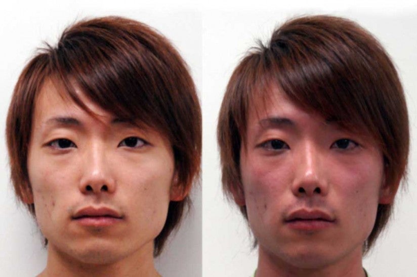 Asian man exhibiting effects of acetaldehyde build-up