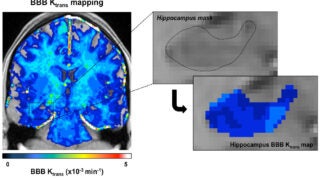 Brain imaging that shows blood brain barrier mapping