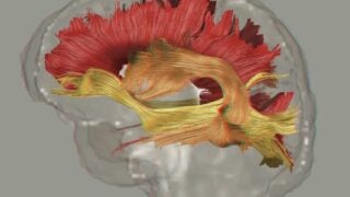 fiber pathways in schizophrenia