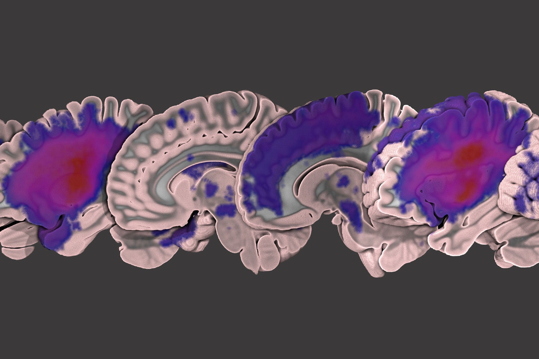 Shared database of brain images aims to boost stroke patients' recovery ...