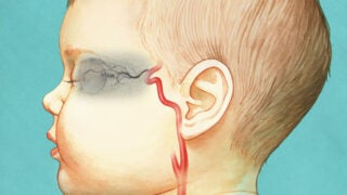 Child's eye with cancer illustration