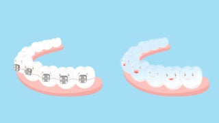 braces illustration