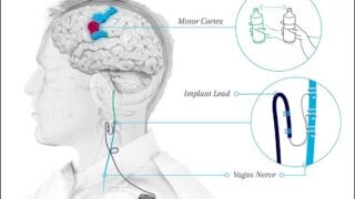 stroke overview illustration