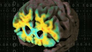 Brain with amyloid plaque deposits