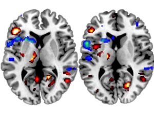 fMRI imaging of a brain