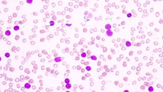 Blood cell formation from bone marrow-Acute lymphoblastic leukemia