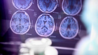 Alzheimer’s blood test: Brain scans