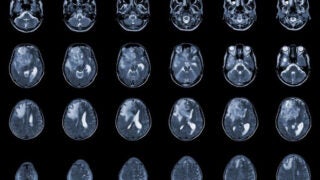 MRI brain imaging of glioblastoma