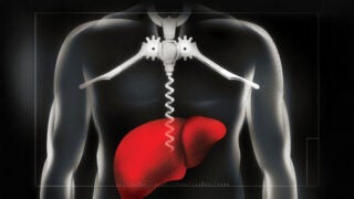 USC doctors are working to mitigate a post-COVID rise in alcohol-related liver disease. (Illustration/Brian Stauffer)
