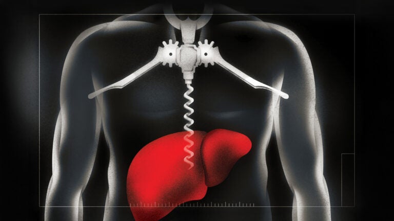USC doctors are working to mitigate a post-COVID rise in alcohol-related liver disease. (Illustration/Brian Stauffer)
