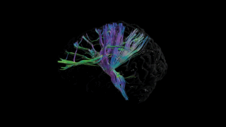 MRI scan of a green, blue and purple internal brain structure on a black background