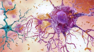 Image with Alzheimer’s research